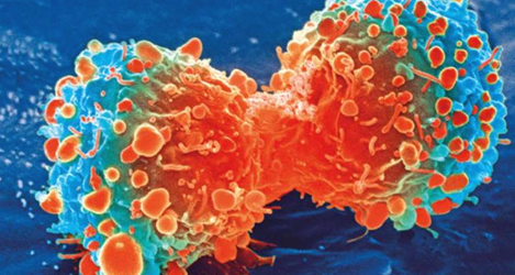 验血可以迅速将晚期乳腺癌患者与靶向治疗相匹配