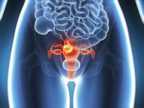 测试可测量免疫反应以改善卵巢癌的诊断