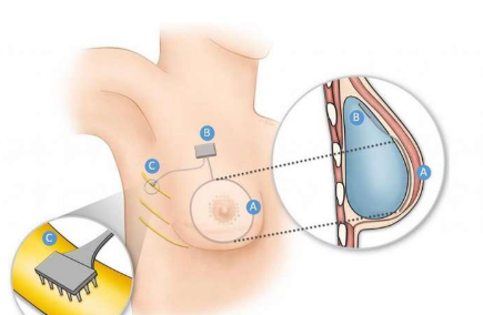 研究人员如何通过植入物恢复乳腺癌幸存者的感觉