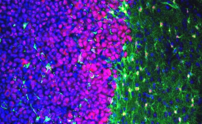 科学家发现脑肿瘤会影响正常有用的细胞