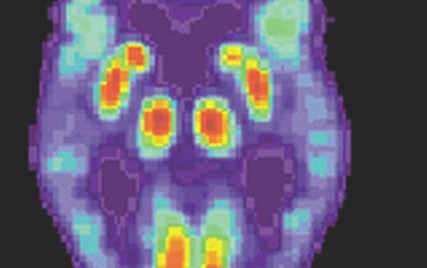 阿尔茨海默氏症的筛查数据将高淀粉样蛋白水平与早期疾病联系起来