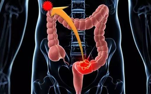 当特定蛋白被阻断时放射疗法对结肠癌的治疗效果更好