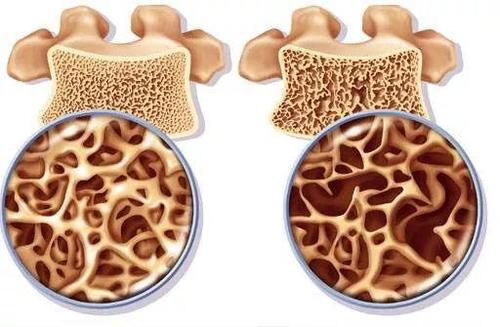 骨质疏松症筛查无需证明有益