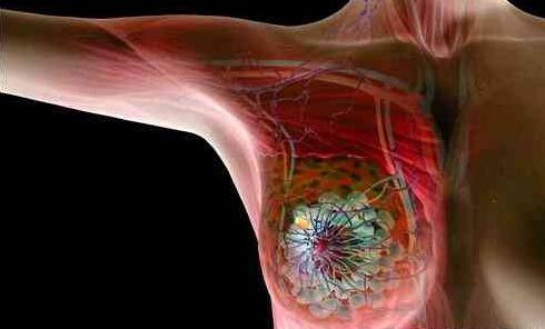 靶向治疗药物可帮助患有侵袭性乳腺癌的女性更长寿