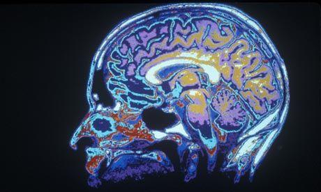脑部扫描可能为自杀风险提供线索