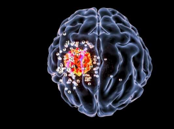 微小的纳米颗粒为脑癌的治疗提供了巨大的潜力