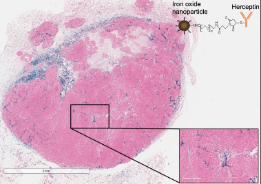 在小鼠和人类细胞中进行的实验中提供纳米粒子治疗癌症的最佳方法