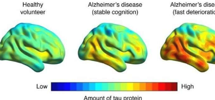 脑成像可以预测阿尔茨海默氏症相关的记忆力减退