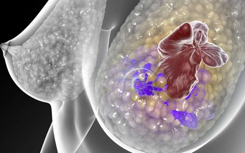 研究小组通过靶向治疗缩小了小鼠的乳腺癌肿瘤