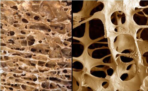 骨质疏松症药物与降低过早死亡风险有关