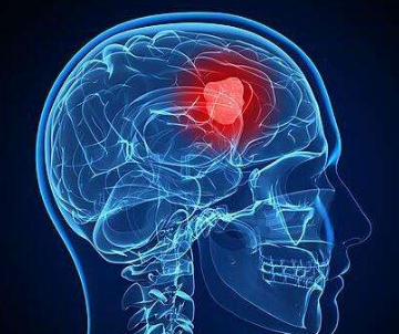 研究人员发现了致命脑癌的新药靶标