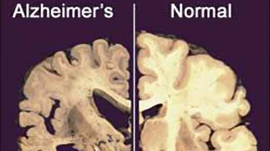 治疗可减少阿尔茨海默氏症的损害