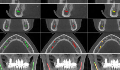 人工智能使牙医的工作更加轻松 新模型有助于对下颌管进行定位