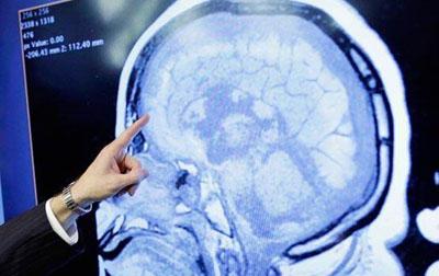 路德维希癌症研究概述了脑肿瘤的免疫状况