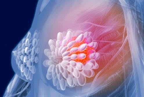 IDIBELL研究人员将乳腺癌中对化学治疗药物的抗性联系起来