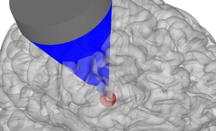 研究人员发现超声波可能为脑部疾病提供新的治疗方法