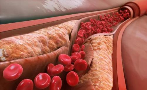 首次长期估计表明胆固醇水平与心脏病和中风的风险之间存在关联