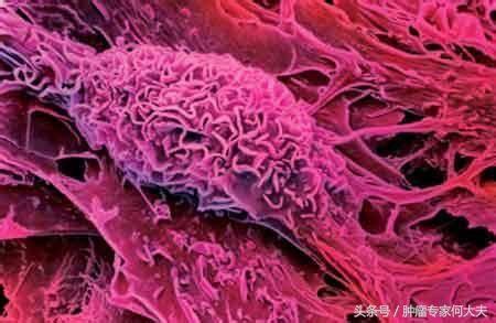 血癌如何窃取周围健康骨髓细胞的部分茁壮成长