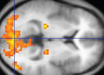 分析功能磁共振成像数据的新方法为改善精神分裂症的治疗提供了途径