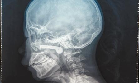 即使轻微的头部外伤也会发生血脑屏障损害