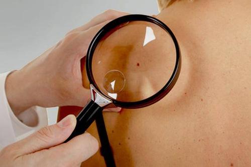 研究强调需要量身定制的皮肤癌预防计划