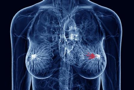 如果手术前根除肿瘤 HER2+乳腺癌患者的寿命将延长