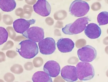 新的干细胞疗法可增强抗白血病能力