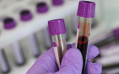 研究发现 血液测试有助于在症状出现之前发现癌症