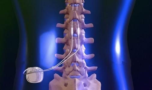 脊髓刺激是一种安全有效的慢性疼痛治疗方法
