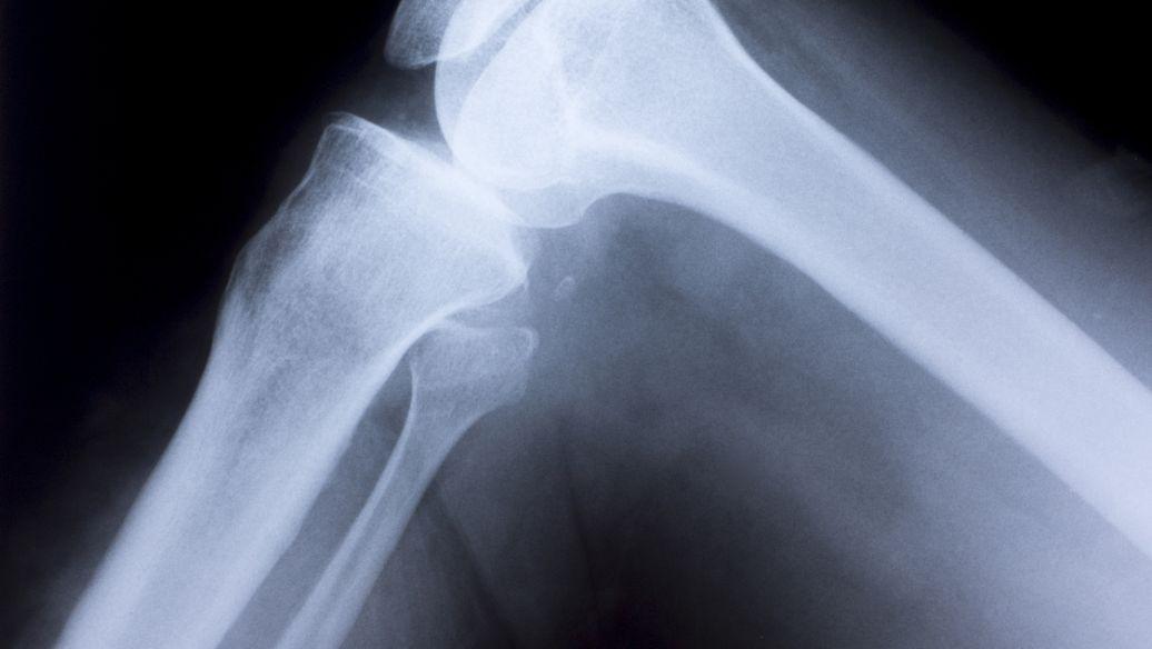 双膦酸盐可降低骨质疏松性骨折的风险