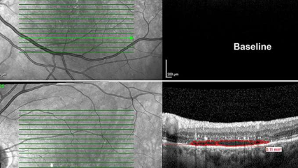左旋多巴可能改善黄斑患者的视力