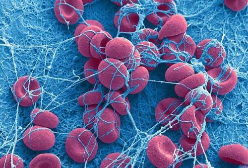 尿液中的凝血蛋白被发现为狼疮性肾炎的生物标志物