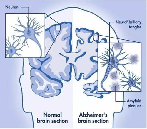 功能失常的内体是神经退行性变的早期迹象