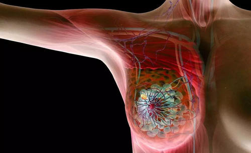 遗传研究可提供迄今为止最全面的乳腺癌风险图
