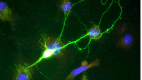 研究发现 失去身份的神经元是阿尔茨海默氏病的标志