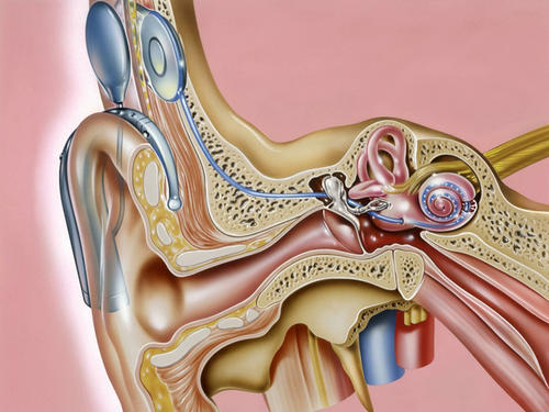 利用人工耳蜗更好地聆听工程音乐