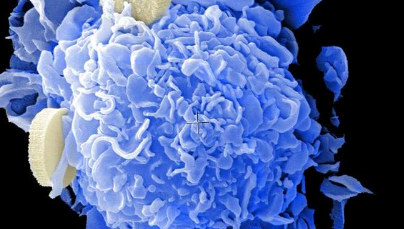 HPV株可能影响宫颈癌的预后
