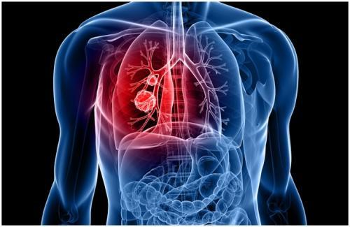 非吸烟者的肺癌对治疗的反应可能不同