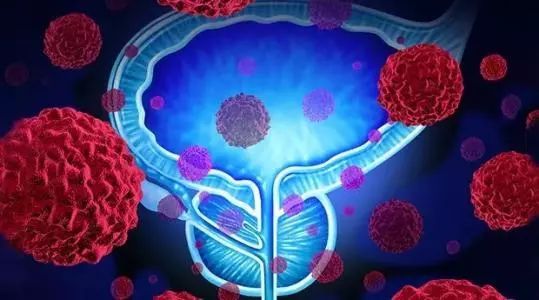 研究人员宣布开发针对前列腺癌无创尿检的进展