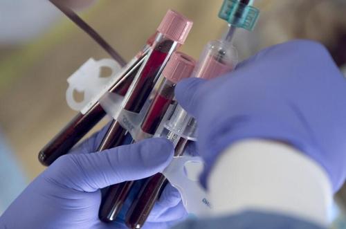 邓迪大学的一个团队设计了一项新的血液测试