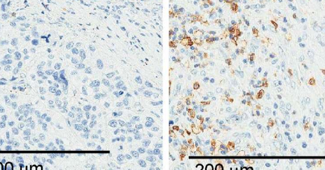 研究人员鉴定出有助于肺癌细胞逃避免疫系统的RNA分子