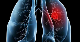 重新思考哪些免疫细胞是对抗肺癌的最佳武器