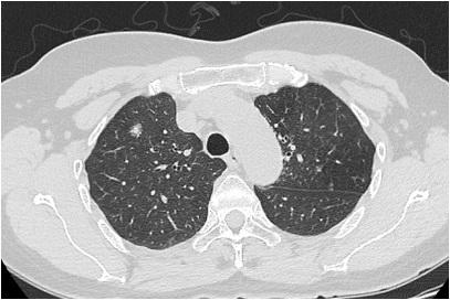 研究发现县级早期肺癌的手术率差异很大