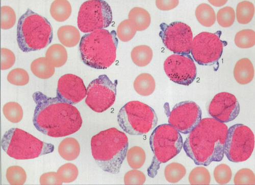 一种新的纳米复合物可阻断急性髓性白血病肿瘤细胞而不会损害健康细胞