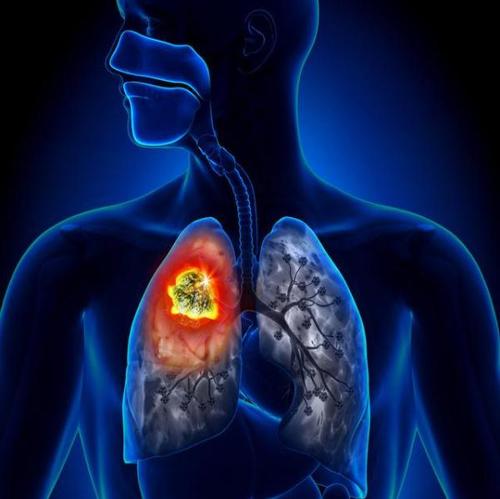 科学家将普通免疫细胞与肺癌检查点抑制剂的失败联系起来