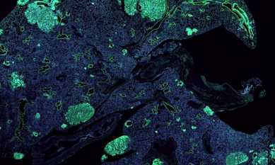 癌细胞利用神经细胞技巧从一个器官扩散到另一个器官
