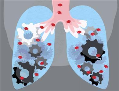 由人类细胞制成的药物载体可以治愈肺部感染