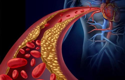 胆固醇可以衡量某些人群的心脏病和中风风险