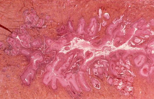 哥伦比亚研究评估宫内节育器的宫颈癌风险