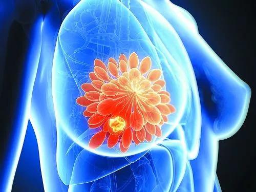AI如何使乳腺癌的治疗决策更加准确